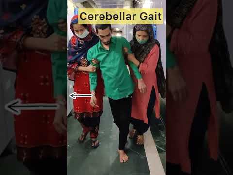 Cerebellar Gait #cerebellum  #cns #ataxia   #shorts