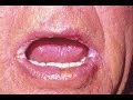 Get Rid Of Angular Cheilitis(Whitish Deposit In Corner Of Lips)