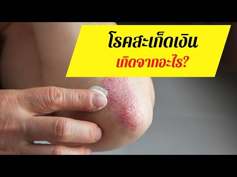 รูปภาพเท้าข้อเท้ากลาก ในการรักษาโรคสะเก็ดเงิน vulgaris เล็บ