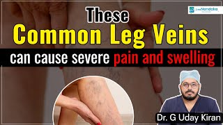 Varicose Veins: Symptoms, Risk Factors ,Treatment | Blue Veins in Legs |