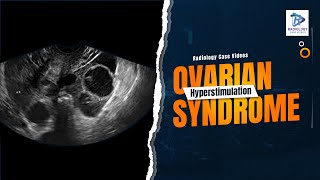 Ovarian Hyperstimulation Syndrome#Gowthami.Ch #Radiology Case Videos