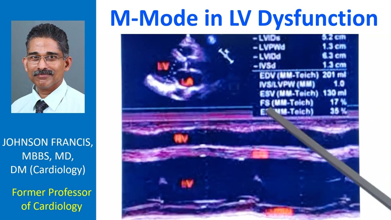 M-Mode Echocardiogram in Left Ventricular Dysfunction