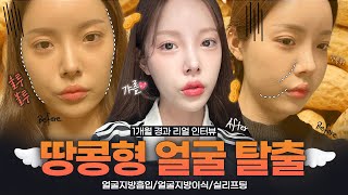 실리프팅 + 얼굴지방흡입 + 지방이식후기｜붓기 아닌 진짜 변화｜거짓없는 찐 성형후기