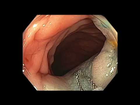 Colonoscopy: Sigmoid Colon Polyp Resection - Large Polyp