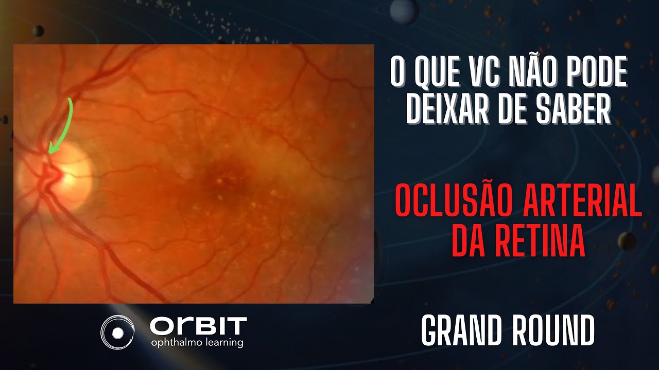 Grand Round 009   oclusão arterial da retina   o que vc precisa saber
