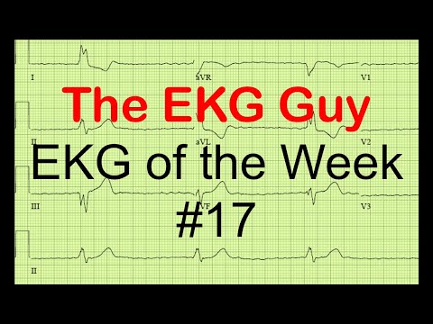 EKG/ECG of the Week #17 | The EKG Guy - www.ekg.md
