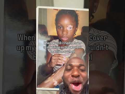 When she was 10 tried to cover up her vitiligo so that wouldn’t be bullied at school 😳 #shortvideo