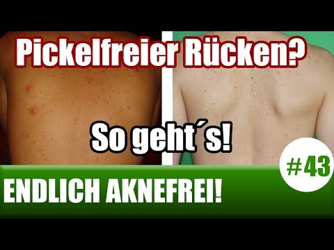 Staphylokokken in der Prostata Laser-Vaporisation der Prostata + Preis