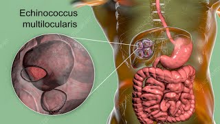 Liver Cyst Surgery: What Happens Inside?