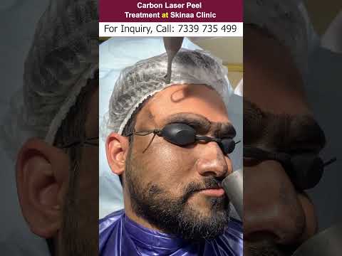 Carbon Laser Peel treatment at Skinaa Clinic | Viral #shorts