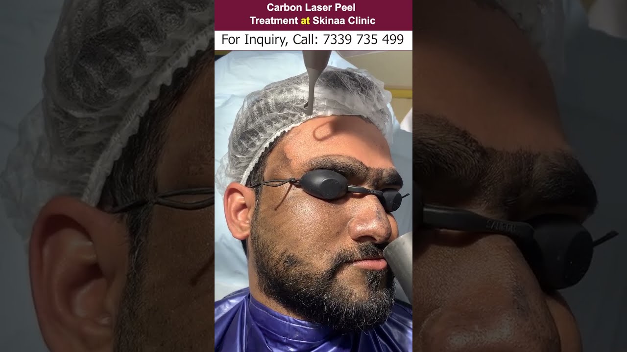 Watch video Carbon Laser Peel treatment at Skinaa Clinic | Viral #shorts Now Carbon Laser Peel treatment at Skinaa Clinic | Viral #shorts