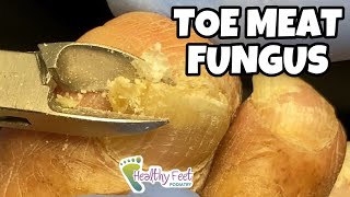 TRIMMING AROUND MOIST TOE MEAT UNDER THICK FUNGUS TOENAILS!
