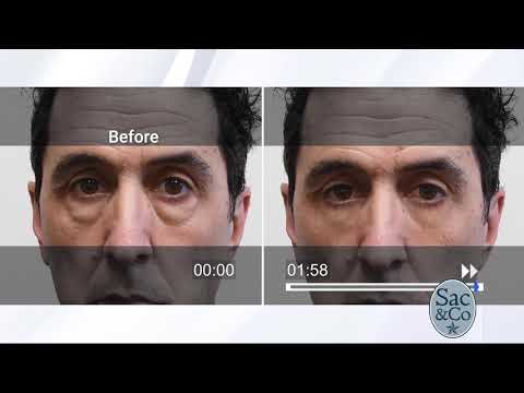 Feel insecure about under eye bags, dark circles or wrinkles? Plexaderm may be for you! | Sac & Co.