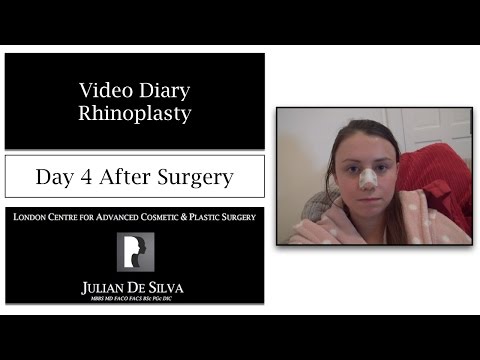 5 Rhinoplasty & Septoplasty Video Diary  Day 4 After Surgery