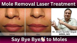 Mole | मस्से | Skin Tags | Papilloma |  Wart Removal Laser Treatment | Say Bye Bye to Moles