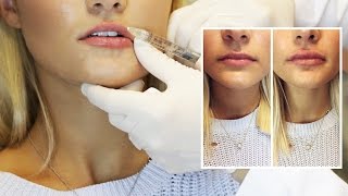 Lip Filler Experience | Start to Finish with 1 Syringe of Juvederm
