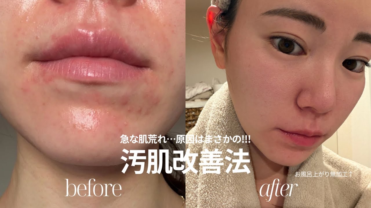 肌荒れ | 原因不明の肌荒れ、これで治った!!!🥚✨