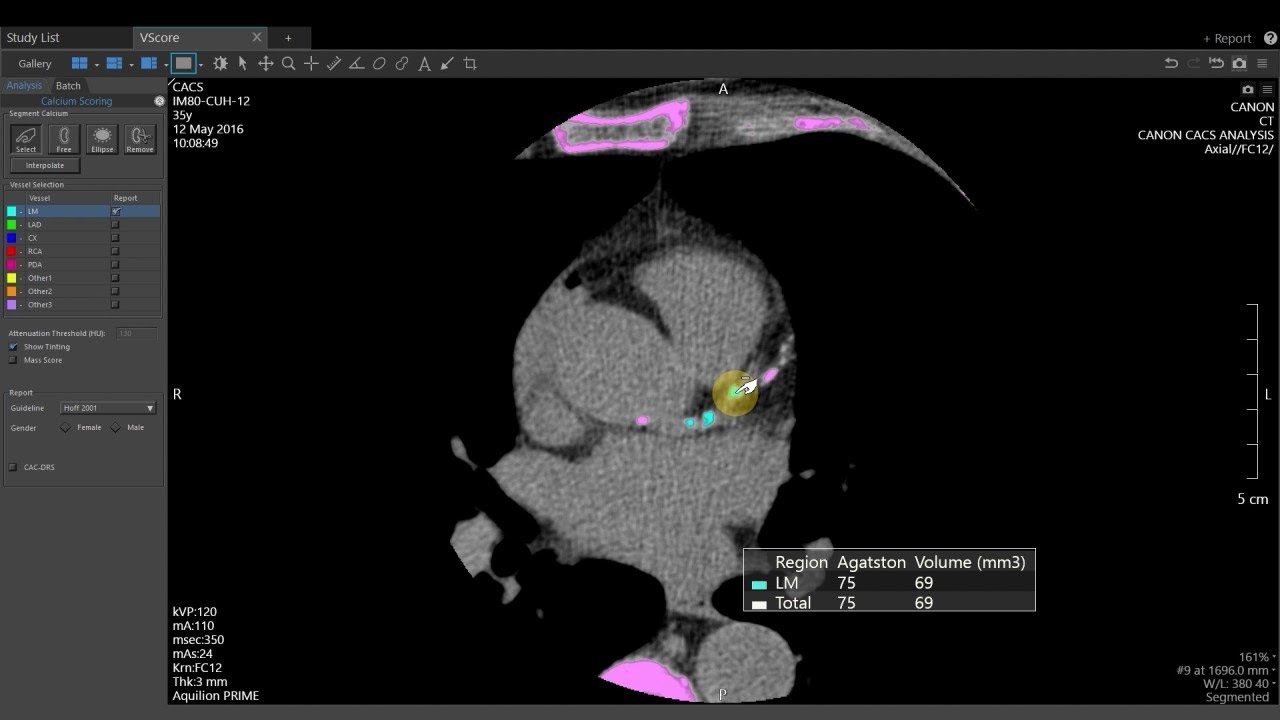 Vitrea Applications Demonstrations | CT VScore