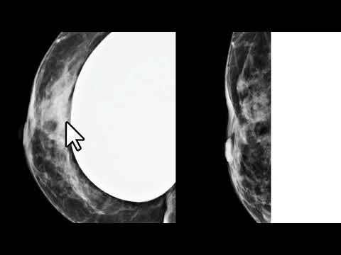 Melhora da qualidade da mamografia através da manobra de Eklund