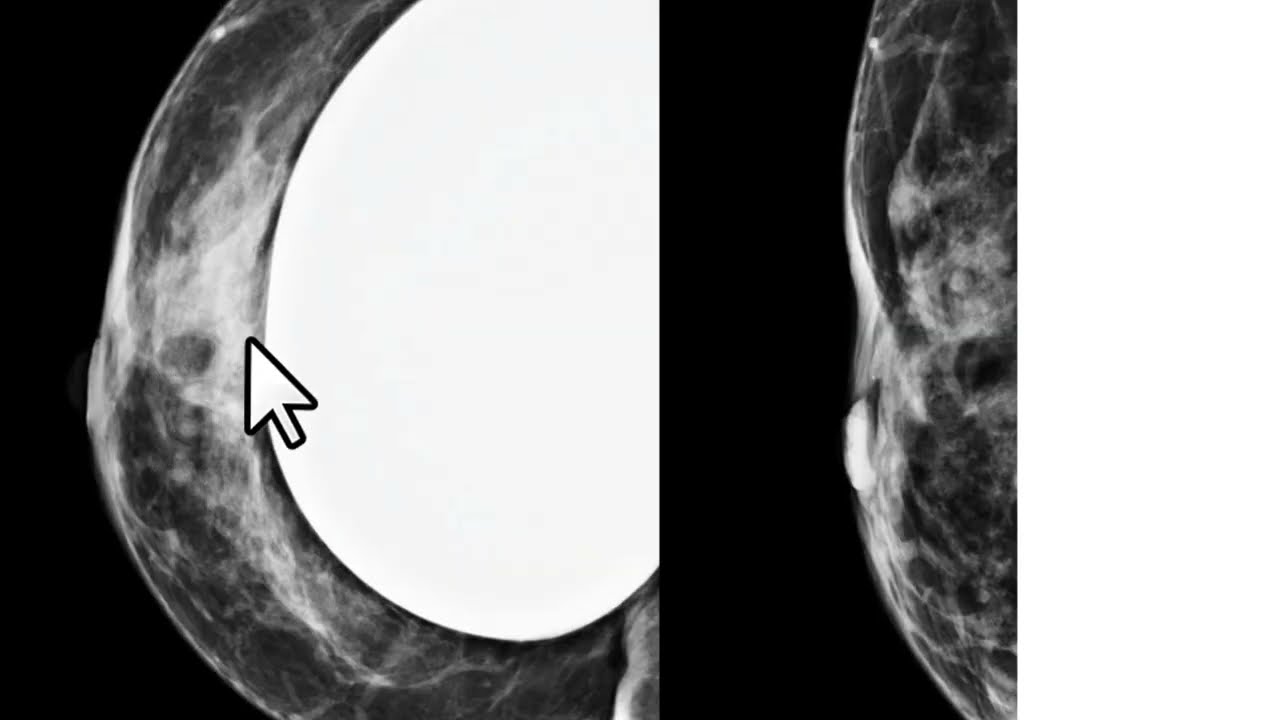 Melhora da qualidade da mamografia através da manobra de Eklund