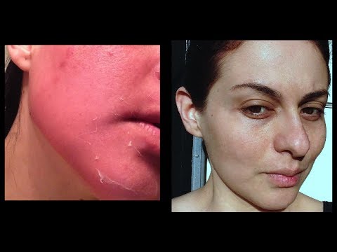 Creme con acidi da lentiggini Eliminazione di posti pigmentary di risposte ipl