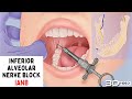 Inferior Alveolar Nerve Block IANB