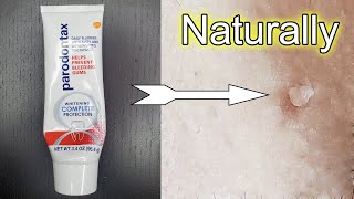 How to Remove Skin Tags Naturally Fast // How To Remove Skin Tag // Skin Tag Removal