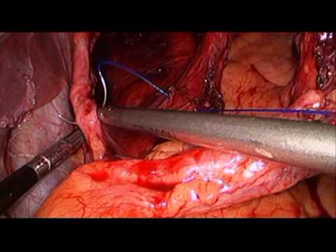 Laparoscopic Hiatal Hernia Repair 