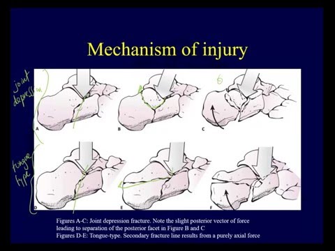 Calcaneal fractures - Anatomy, evaluation, classification (OTA lecture series IV L15a)