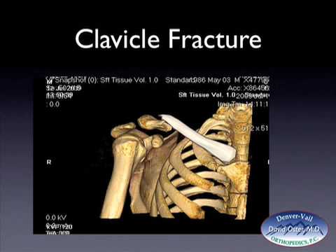 clavicle and scapula fx web