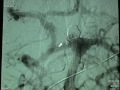 Endovascular Coiling - Previously Coiled Basilar Apex Aneurysm