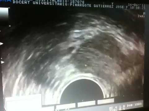 Video Frau des Prostata Mann massiert Alle Ursachen der Prostatitis