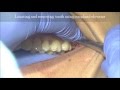 Highly placed upper wisdom molar extraction with only luxator