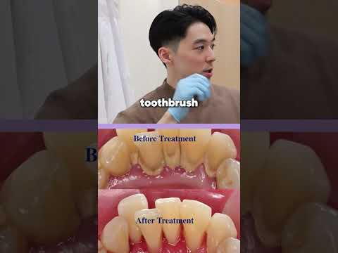 What happens if you don't floss correctly? [Common dental myths]