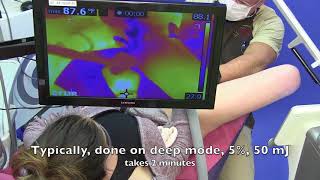 Download lagu Fractional CO2 laser vagina for tightening mp3 Download lagu Fractional CO2 laser vagina for tightening mp3