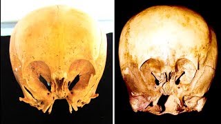 The Mysterious Starchild Skull: Myth Or Something That Cannot Be Explained? The Mysterious Starchild Skull: Myth Or Something That Cannot Be Explained?