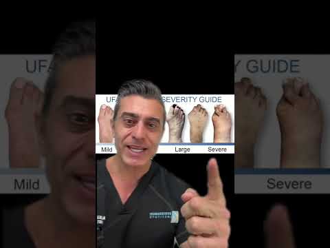 How soon should you treat your bunions?