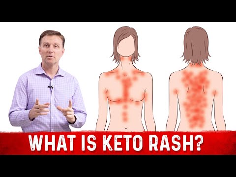 What is a Ketone Explained By Dr Berg