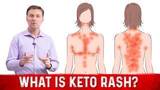 What Is Keto Rash?