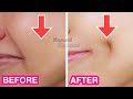 How To Get Dimples Fast & Naturally! Simple Facial Exercises to get Dimples without Surgery