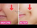 How To Get Dimples Fast Naturally Simple Facial Exercises To Get Dimples Without Surgery