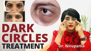 Dark circles| Dark circles treatment| Undereye dark circles cream | Dark circle home remedies