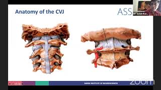ASSI Webinar - Complex CVJ anomalies