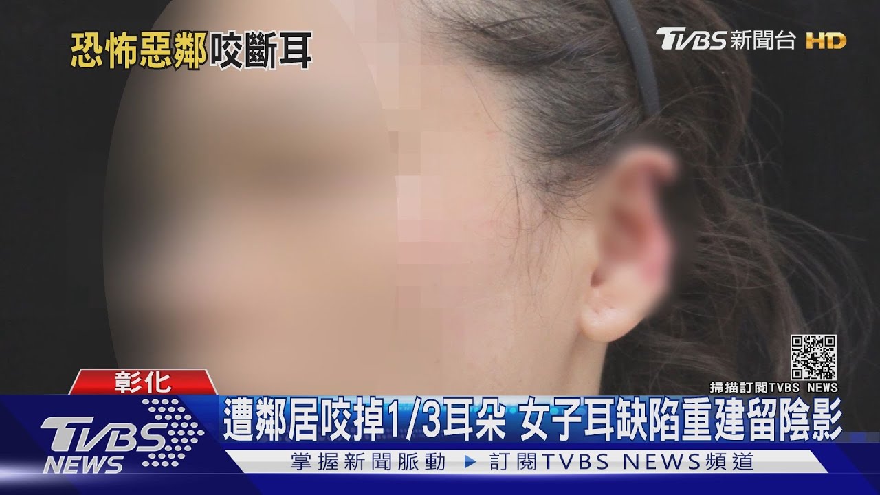遭鄰居咬掉1/3耳朵　女子耳缺陷重建留陰影