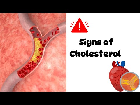 📌 8 Warning ‼️ signs of Cholesterol to find out…