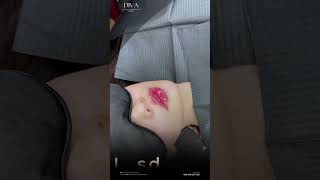 Lip Filler in Poipet