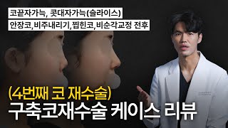 4번째 구축코재수술 케이스 리뷰 [늑떼선생김현주의 수술사례 및 케이스리뷰]