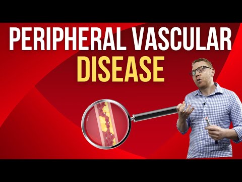 Peripheral Vascular Disease