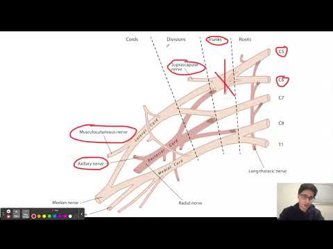 USMLE Step 1 Question of the Day 16; Erb's Palsy