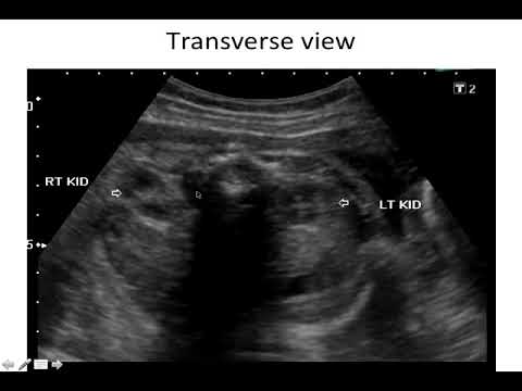 Antenatal Hydronephrosis